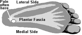 Calcaneal Spur