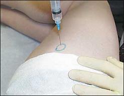 Corticosteroid injection site pain