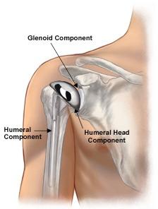 shoulder joint replacement