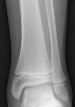 Salter-Harris Type I Fracture